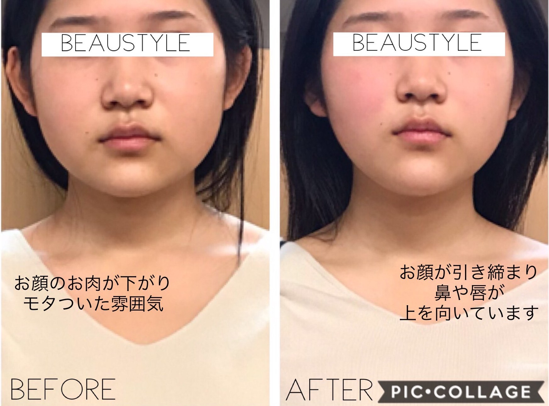 大阪の顔の左右非対称をケアする小顔矯正3