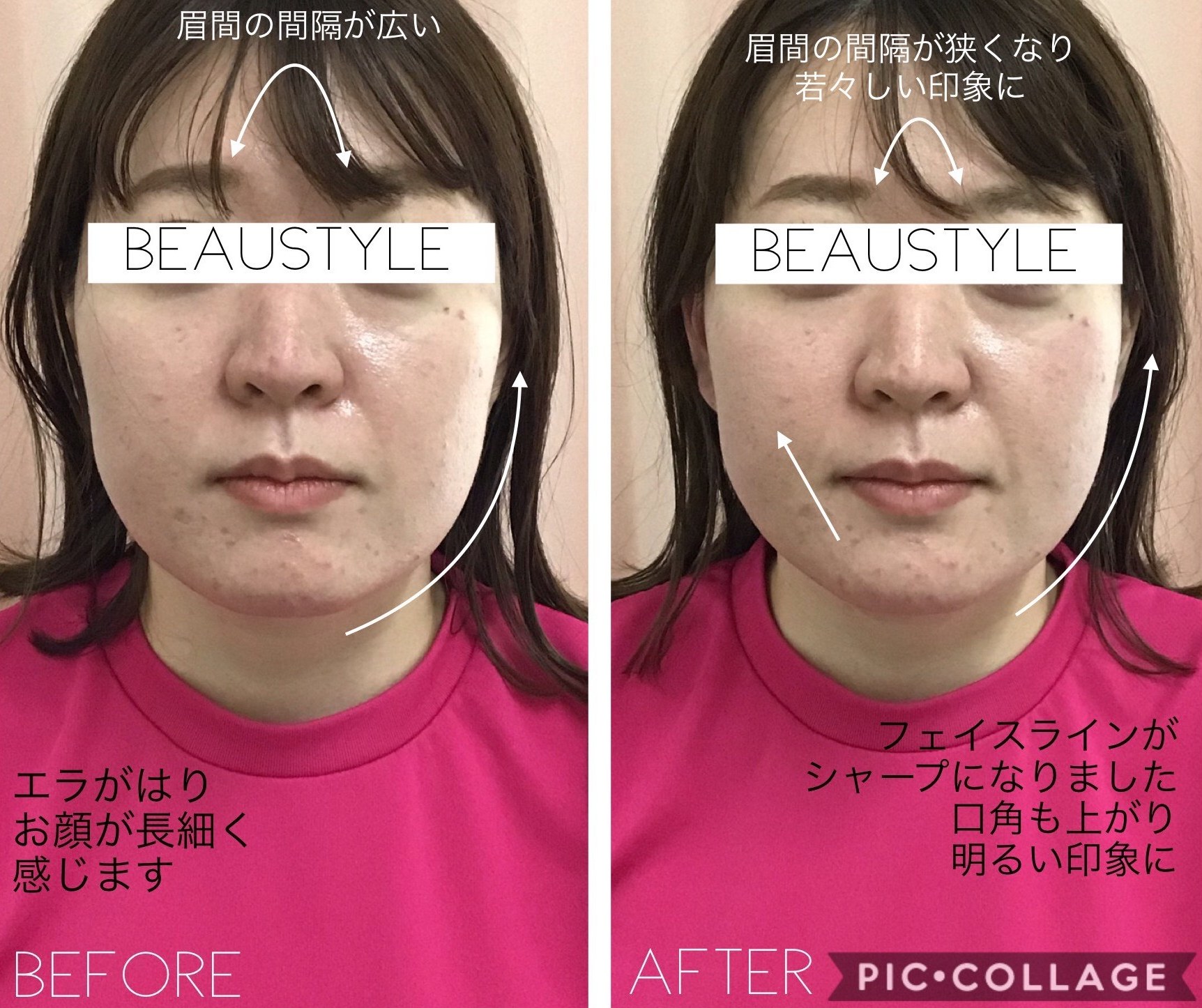 大阪の顔の左右非対称をケアする小顔矯正2